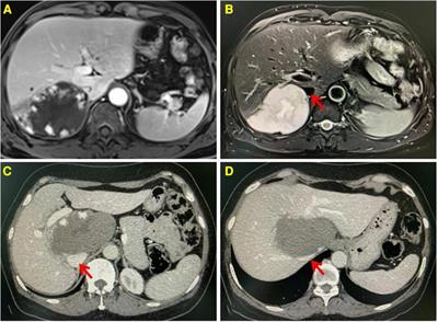 Feasibility of laparoscopic enucleation for hemangioma in special hepatic segments